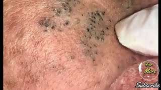 Dr Pop  Deep Blackheads in old Skin removing amp treatment 2020 Part 4 HD [upl. by Othe631]