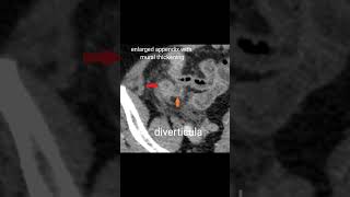 Appendiceal diverticulitis ctscan abdomen [upl. by Obbard211]