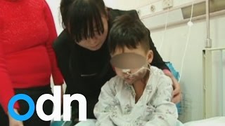 Toddler suffers horrific burns after drinking sulfuric acid [upl. by Krutz373]