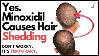 Does Minoxidil Make You Go Bald The TRUTH about Minoxidil Hair Shedding Phase [upl. by Hardan323]