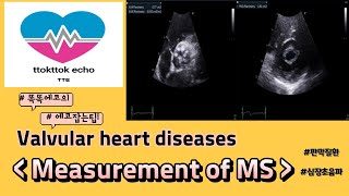 Measurement of MS 승모판 승모판 협착증 승모판협착 평가 승모판협착 측정 MS echocardiography 심장초음파 판막질환 [upl. by Manya]