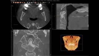 Cervical spine osteosclerosis or metastatic breast cancer [upl. by Annaer753]