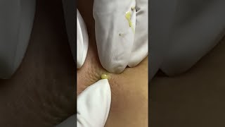 Big Cystic Acne Blackheads Extraction Blackheads amp Milia Whiteheads Removal Pimple Popping shorts [upl. by Mallory837]