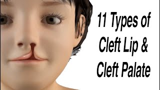 Why Cleft Palates Occur A Scientific Explanation [upl. by Reppart]