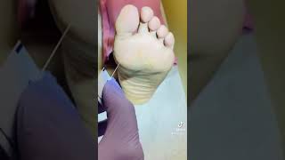 How to do Diabetic foot exam [upl. by Jacquette]