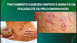 Foliculite tratamento rápido caseiro e eficiente [upl. by Novyad]