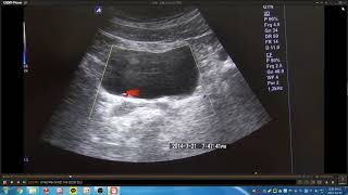 Yoda Kim Ultrasound School978  Dr김문찬 초음파 증례 토의 Urachal cyst [upl. by Lathrop]