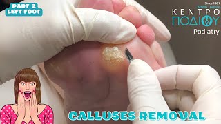 Calluses Removal KentroPodiou feet κεντροποδιου foot podologos podiatrist corn footcare [upl. by Dolora]