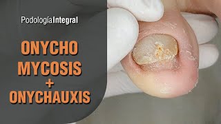 Onychomycosis  Onychauxis podology asmr [upl. by Aurelie209]