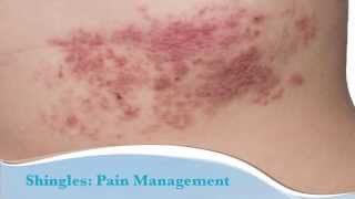 How to treat shingles [upl. by Atiloj]