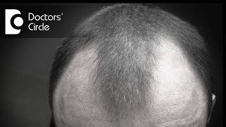 Can minoxidil be helpful in treating bald patches in young men  Dr Rasya Dixit [upl. by Edson]