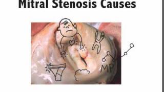 Mitral Stenosis Causes Mnemonic [upl. by Oitaroh847]