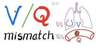 Ventilation Perfusion Ratio VQ and VQ Mismatch  Respiratory Physiology amp Pulmonology [upl. by Ydorb]