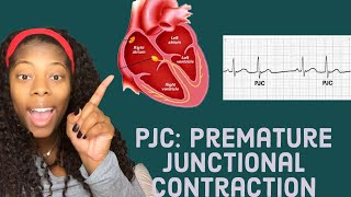 Basic EKG Identifying premature junctional contractions PJCS [upl. by Aleahcim577]