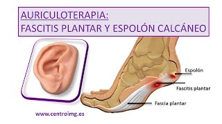 121 Fascitis plantar y Espolón calcáneo  Alivio rápido con AURICULOTERAPIA Centro IMG [upl. by Larochelle]