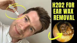 How to remove EAR WAX at home using HYDROGEN PEROXIDE H202 solution  Doctor ODonovan explains [upl. by Edahc]