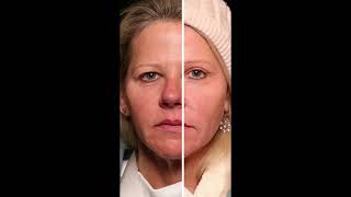 Upper Blepharoplasty w Laser Resurfacing  Before amp After [upl. by Stevy223]