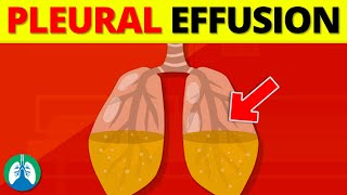 Pleural Effusion Medical Definition  Quick Explainer Video [upl. by Otrevlig]