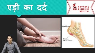 Heel Pain  Plantar Fascitis in Hindi एड़ी का दर्द [upl. by Lundquist]