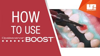 How to Use Opalescence™ Boost™ Professional Teeth Whitening  StepbyStep Procedure [upl. by Barbi]