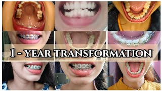 Before and after braces time lapse 1 year braces transformationbraces bracesupdatebracessmile [upl. by Heeley708]