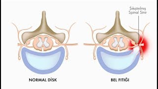 Bel fıtığının belirtileri nelerdir  Prof Dr Onur Yaman Nöroşirürji Uz [upl. by Marcoux982]