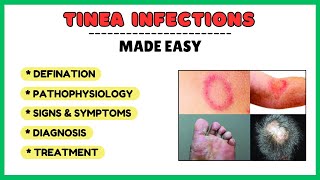 Tinea infection fungal skin infection types risk factors pathophysiology diagnosis treatment [upl. by Hsirrap486]