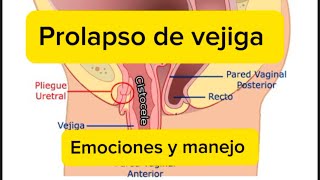 Prolapso de vejiga Manejo emocional [upl. by Janot]