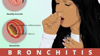 BRONCHITIS Signs and Symptoms and Treatment [upl. by Anailli]