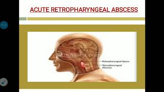 Acute and chronic retropharyngeal abscess [upl. by Ecyla]