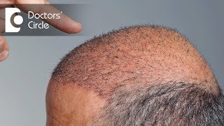 When will newly transplanted hair start to grow  Dr Niranjana Raj [upl. by Arv935]