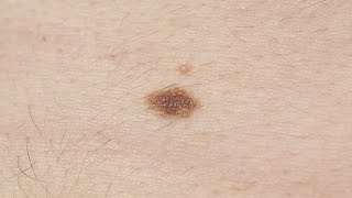 Melanoma symptoms How to spot signs and when to see a doctor [upl. by Melicent]