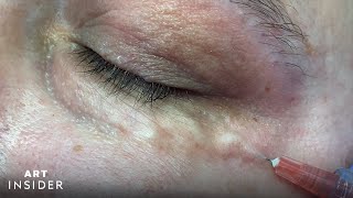 Carboxytherapy Helps Treat Dark UnderEyes [upl. by Ablasor257]