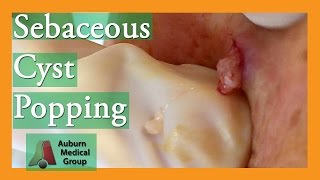 Epidermoid Cyst Popping popping  Auburn Medical Group [upl. by Eselahc]