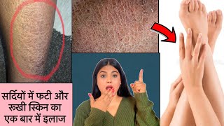 How to repair very Dry and Cracked Skin at Home with Natural Home Remedy [upl. by Lynna]