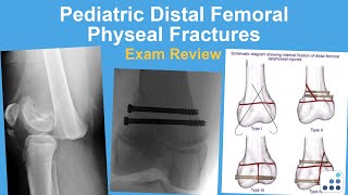 Pediatric Distal Femoral Physeal Fracture Exam Review  Eric Shirley MD [upl. by Nikaniki]