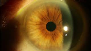 Neurotrophic Exposure Keratitis  Slit Lamp Sodium Fluorescein and White Light [upl. by Oeram310]