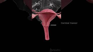 🎗️ Understanding Cervical Cancer What You Need to Know 🎗️ anatomy [upl. by Eornom334]