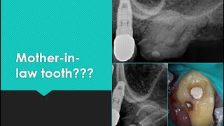 Rotated Broken Down Molar Root Canal [upl. by Nevs]