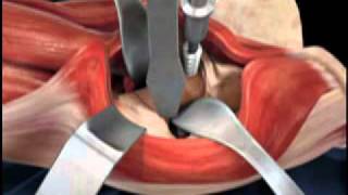 Depuy Direct Anterior Total Hip Replacement Animated Video [upl. by Lladnarc558]