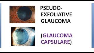 Ophthalmology Pseudo Exfoliative Glaucoma CAPSULARE PEX PEXG Target sign moth eaten Pilocarpine [upl. by Anerat]