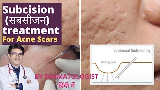 Subcision Treatment For Acne Scars  Subcision Treatment In Jaipur Dr Sunil Kothiwala Dermatologist [upl. by Einnaf18]