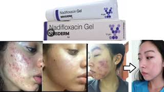 PRISDERM Gel Nadifloxacin Gel [upl. by Stanfield297]