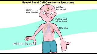 Gorlin syndrome nevoid basal cell carcinoma syndrome  Mnemonic  easy learning [upl. by Llemij]