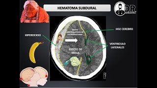 HEMATOMAS INTRACRANEALES EPIDURAL Y SUBDURAL  Como describir una Tomografía de cráneo [upl. by Eedya]