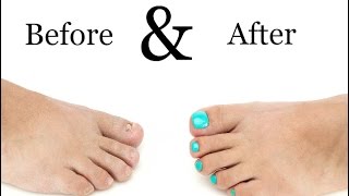 Toenail Treatment  Miracle Gelous Reconstruction [upl. by Spurgeon]