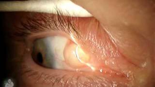 Ophthalmology finding Inclusion cyst on the eye [upl. by Merrile]