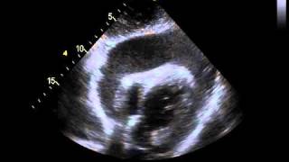 Echocardiography with a Significant Pericardial Effusion [upl. by Adnahs]