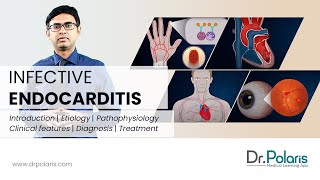 INFECTIVE ENDOCARDITIS  Etiology Pathophysiology Clinical Features Management  Animated [upl. by Bower]