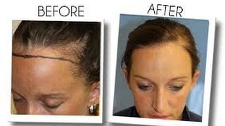 Womens Hair Loss Treatment  Minoxidil  Arganrain  Before and After 15 Results [upl. by Sigmund287]